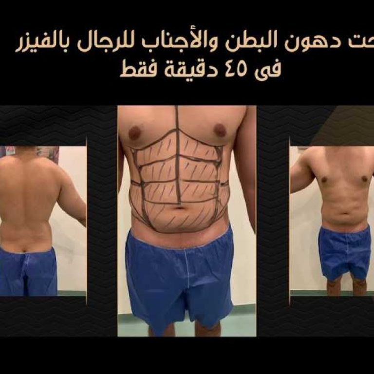 نحت البطن والخصر
