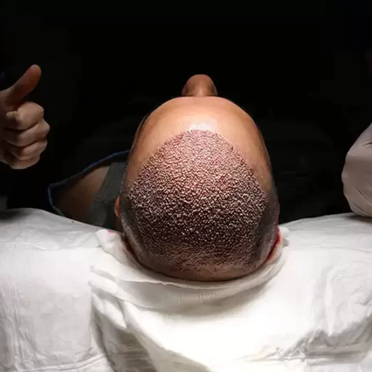 نصائح بعد زراعة الشعر