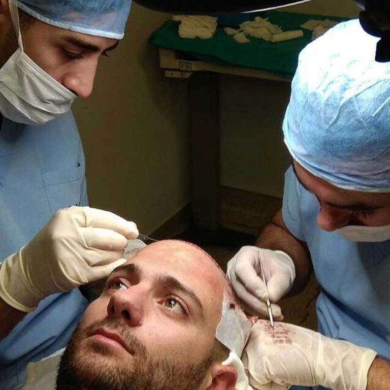 هل زراعة الشعر تسبب السرطان