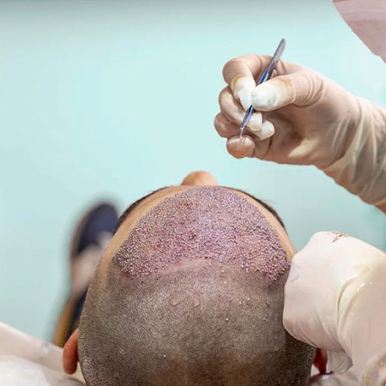 هل زراعة الشعر مكلفة
