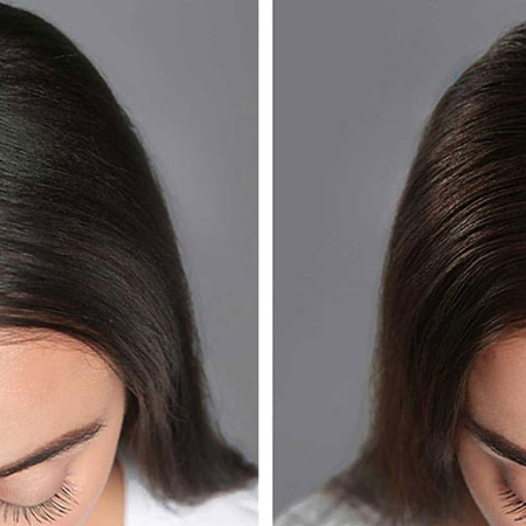 هل زراعة الشعر ناجحة للنساء